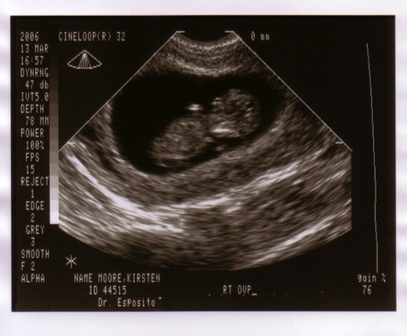 baby_sonogram_1a.jpg