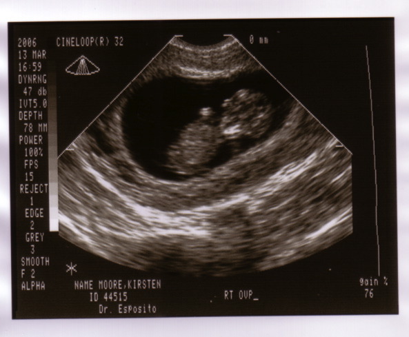 baby_sonogram_1c.jpg