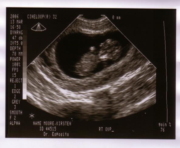 baby_sonogram_1d.jpg